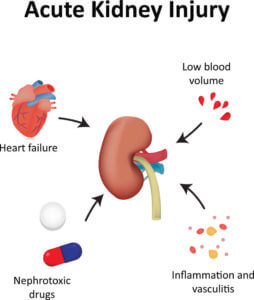 Acute Kidney Injury Diagram Illustration