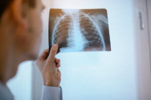 Doctor analyzing chest x ray for lung infection