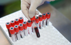 The hand of a hematologist wearing gloves while checking a patient's blood tube.