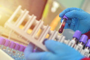 A hematologist is holding tubes of blood samples for testing, along with medical equipment.